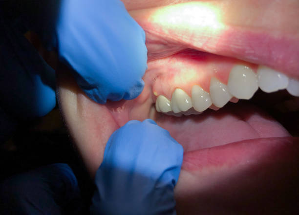 Best Emergency Tooth Extraction in Chesapeake, OH