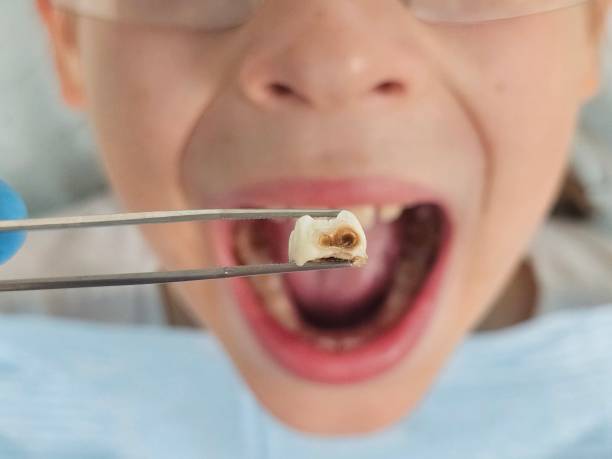 Best Emergency Treatment for Dental Infections or Abscesses in Chesapeake, OH
